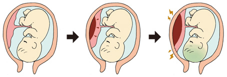 常位胎盤早期剥離