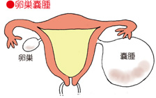 卵巣嚢腫