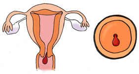 子宮頚管ポリープ